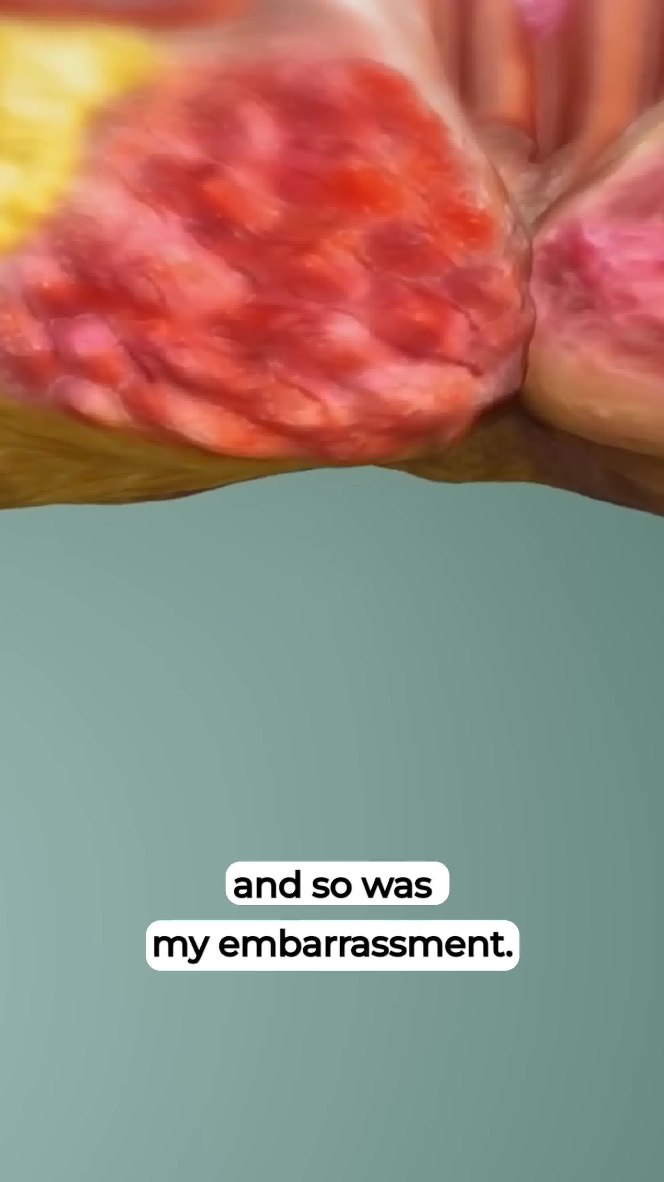 Fast Hemorrhoid Relief