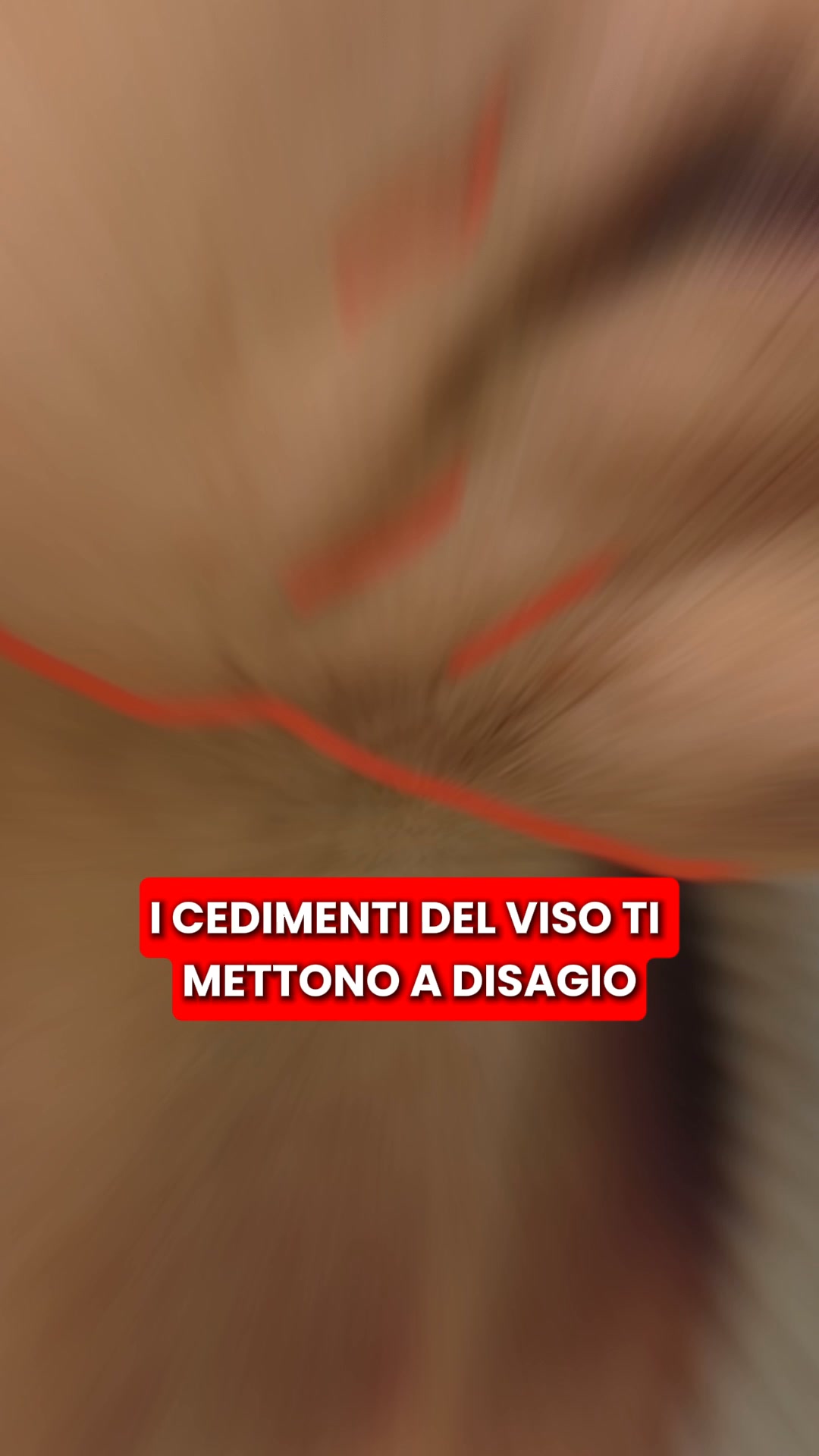 Scopri il kit micro-infusione Renovae