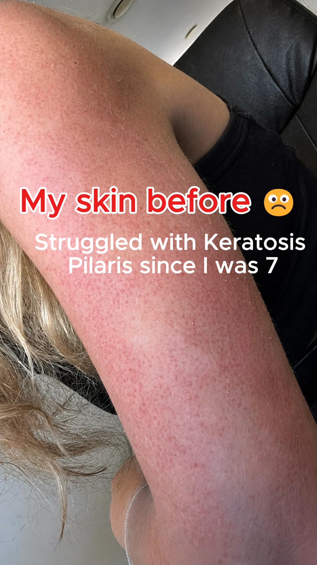 Real Results For Rough KP Skin