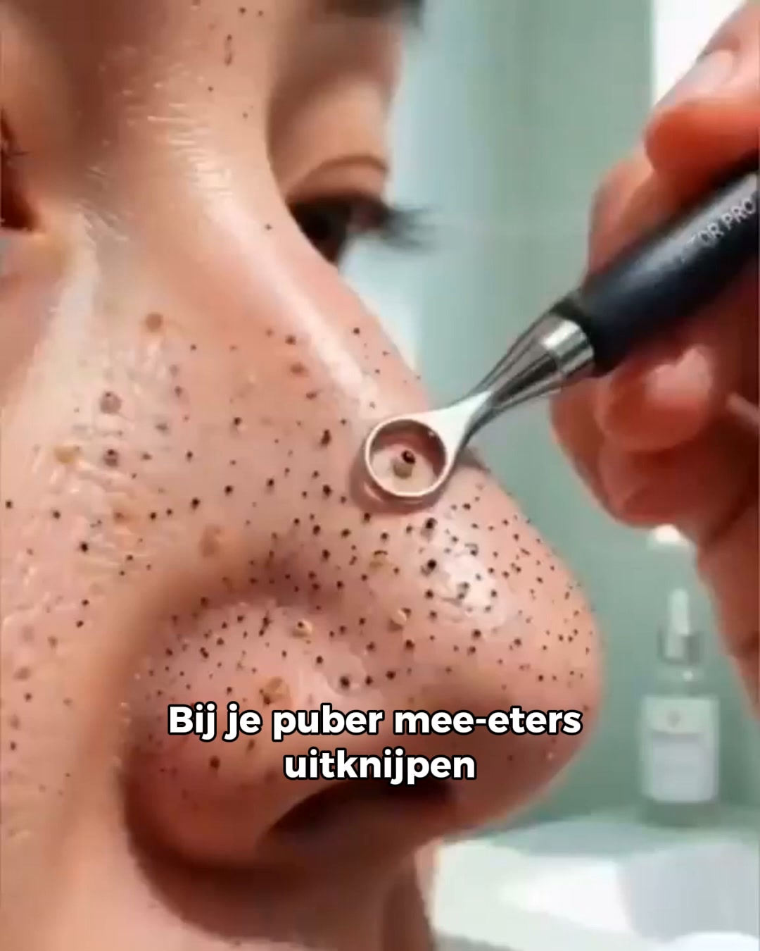 Stop Acne - Bespaar 50%
