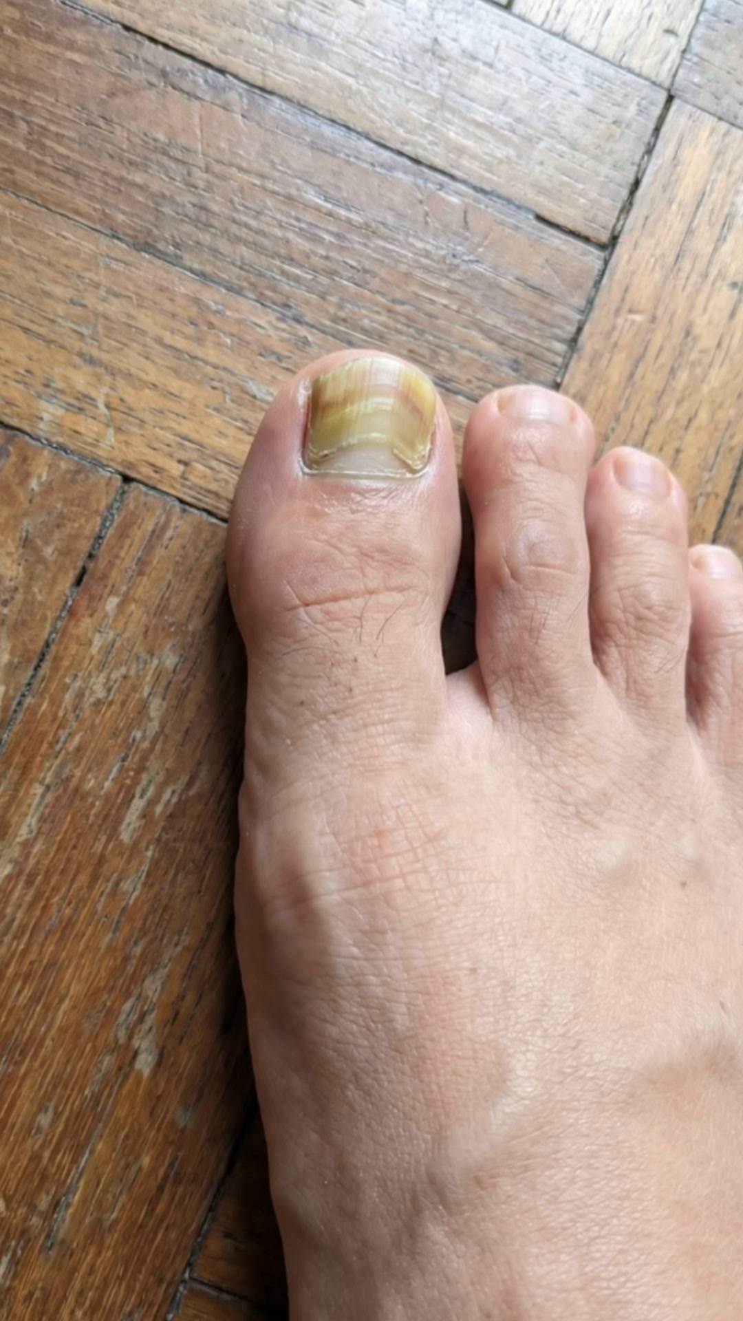 Watch this if you have toe fungus