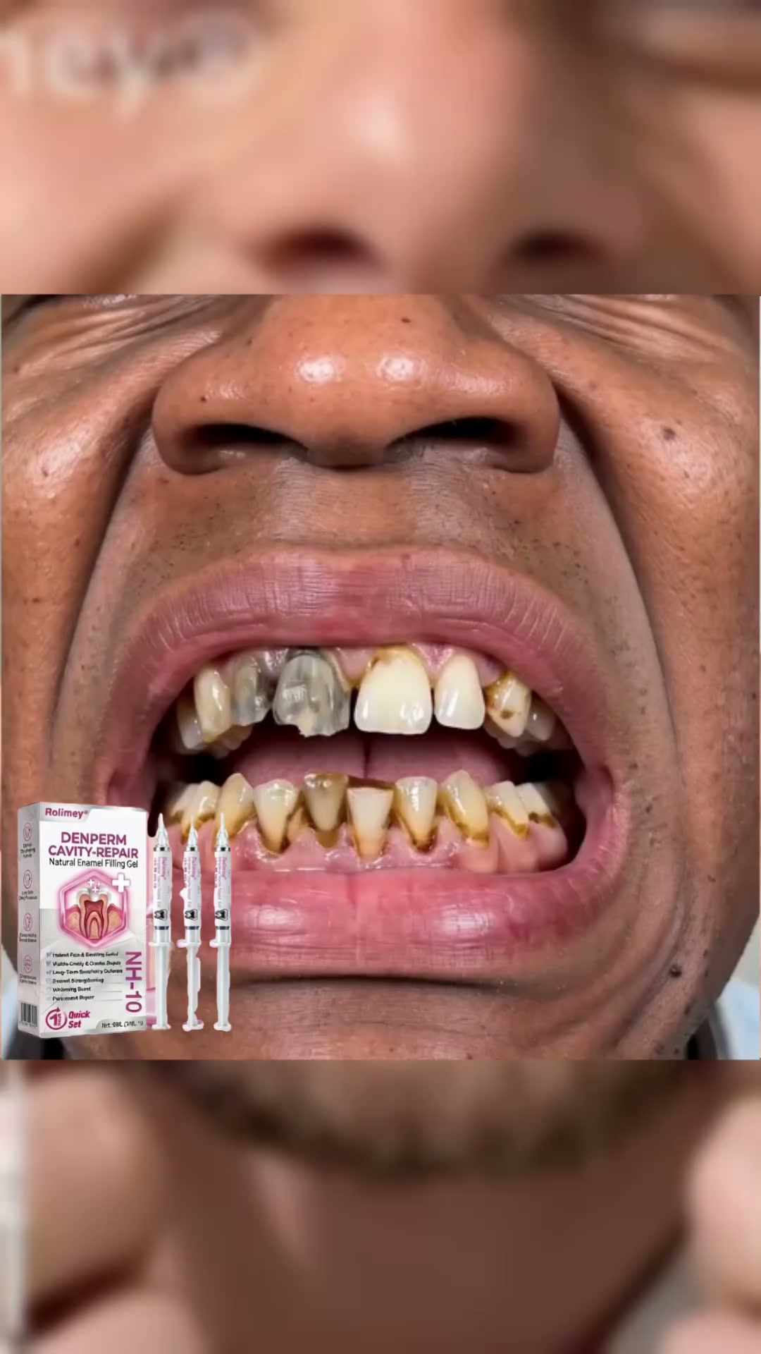Cavity Repair FDA-Recognized 10% Nano-Hydroxyapatite (NH-10) | Delivery within 2-4 working days | Full refund guarantee