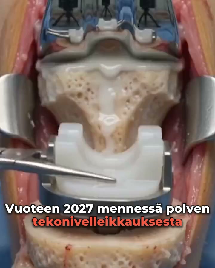 Polvikipua vai nivelrikkoa?