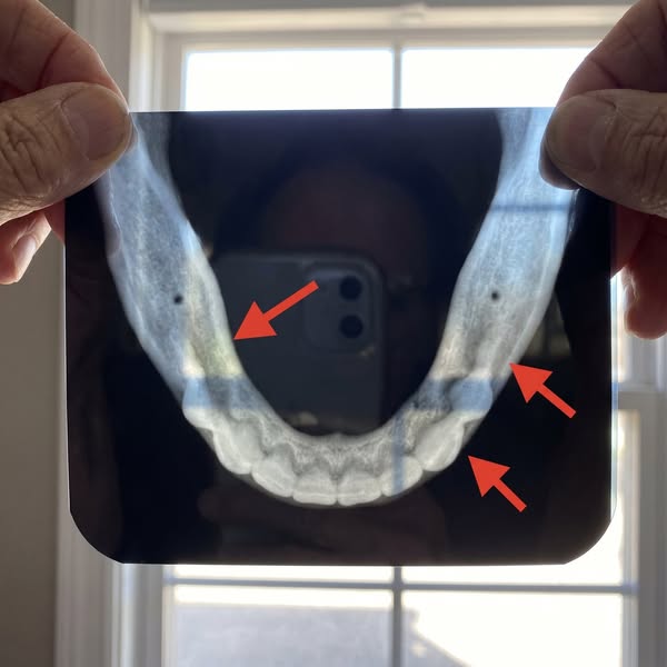 Lisez ceci si vous portez un dentier