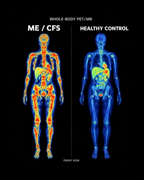 I Was Diagnosed With Chronic Fatigue (ME/CFS) At 34. I Have A Three-Year-Old And I Cannot Get Off The Floor Some Days.