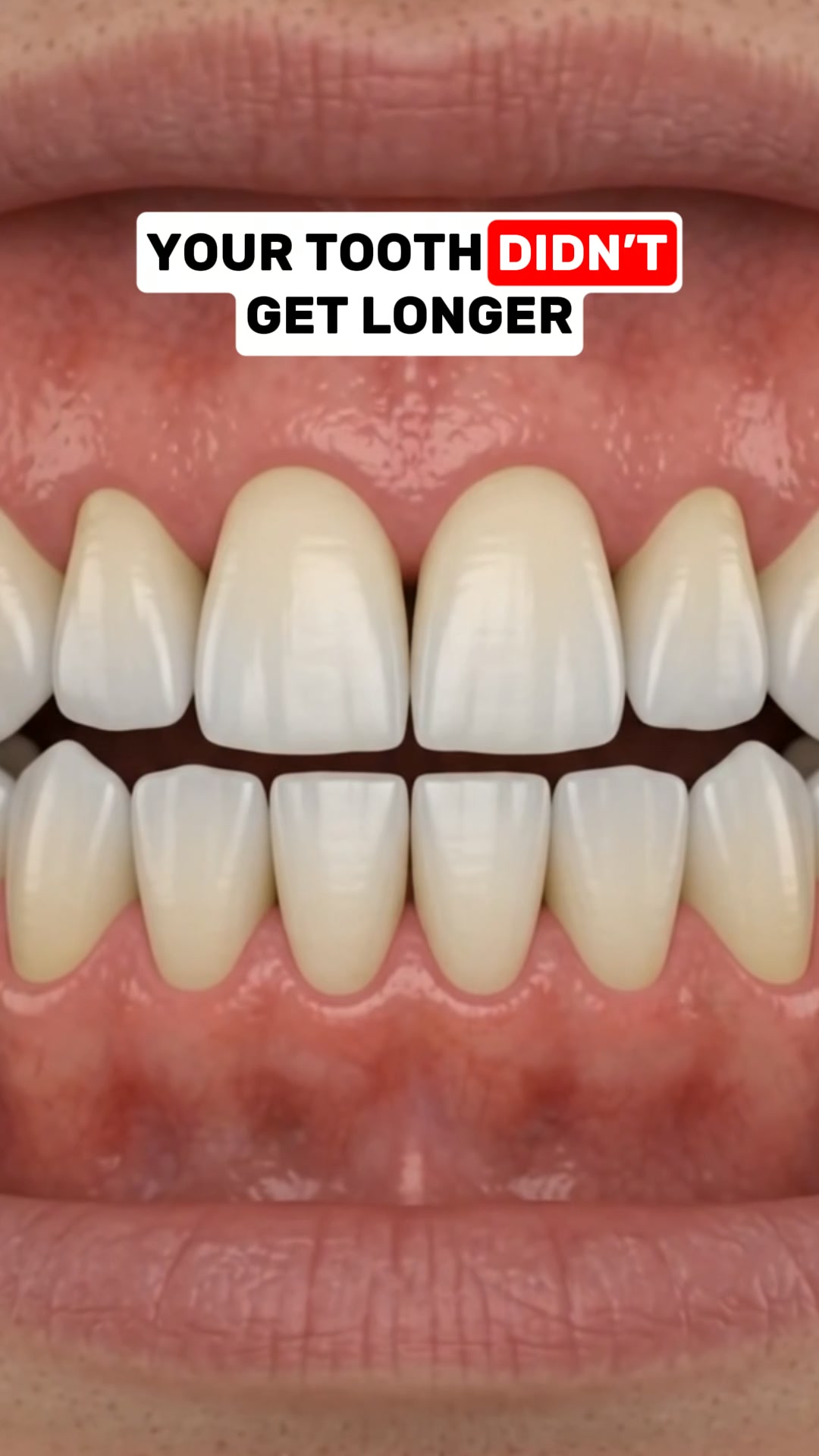My Gums Kept Pulling Back