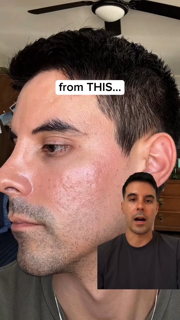 I Stopped Thinking About My Acne Scars