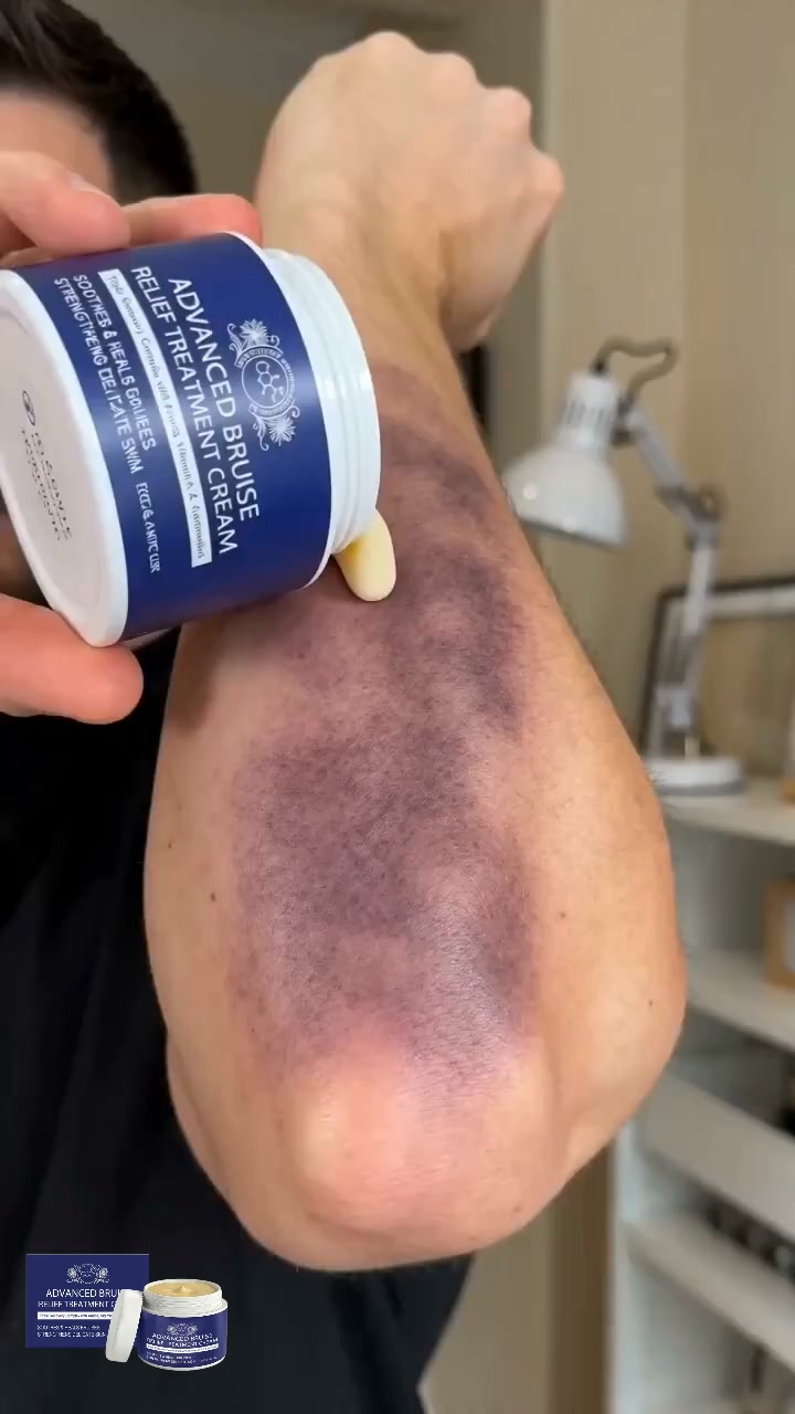 The Truth About "Miracle" Bruise Creams