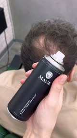 Seeing More Scalp Lately?