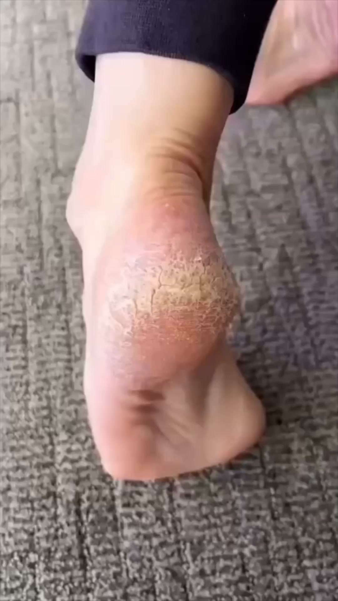 Des pieds lisses. En quelques minutes, C'est garanti.