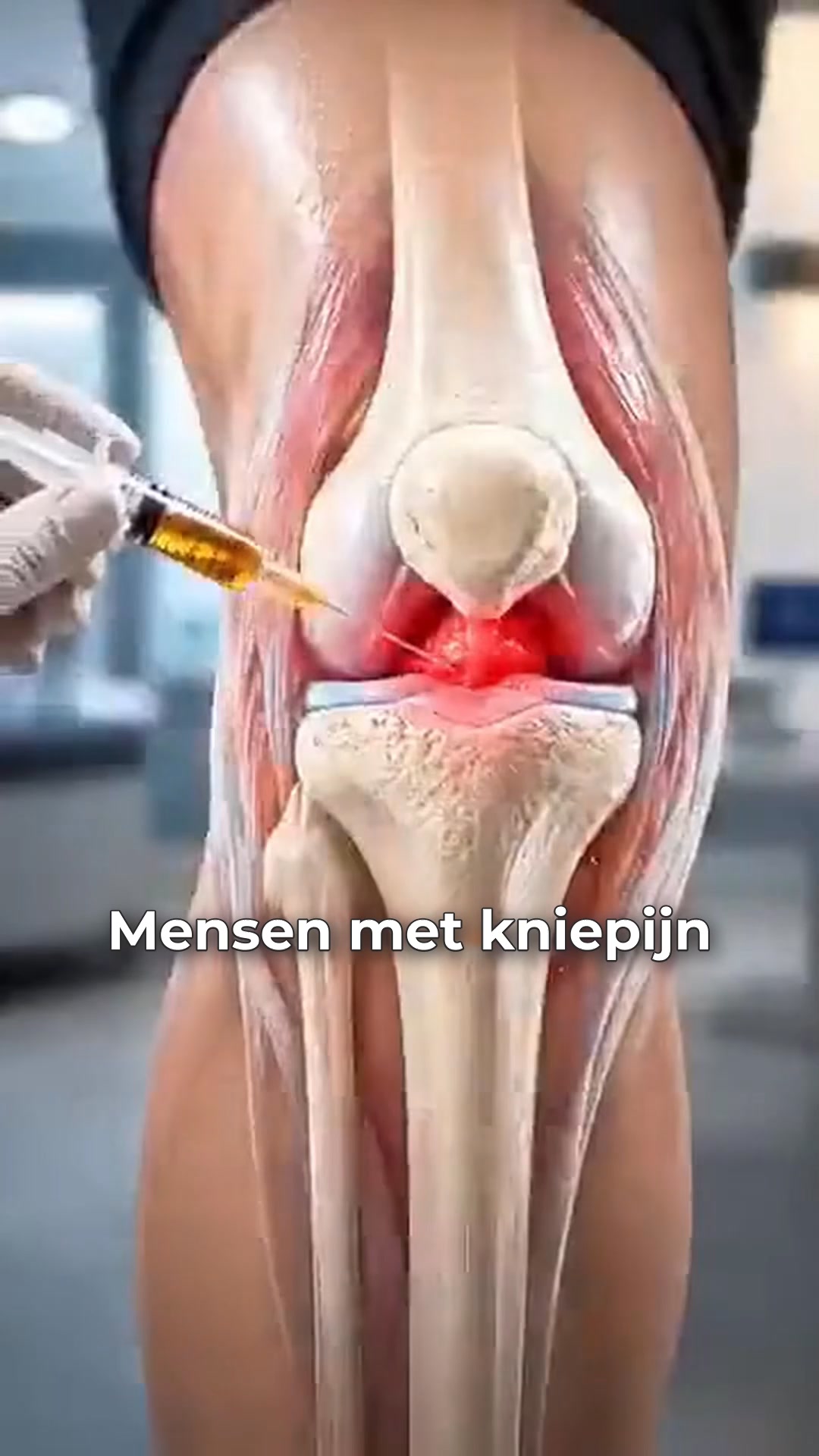 Kniepijn of artrose?