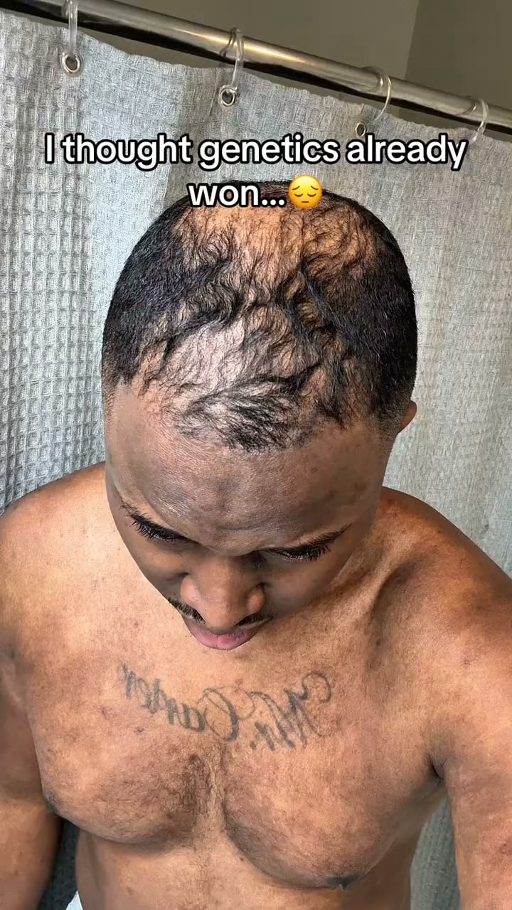 Hair thinning at the crown or temples?
