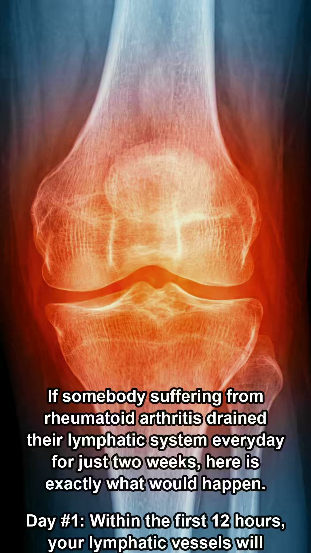 Rheumatoid Arthritis?