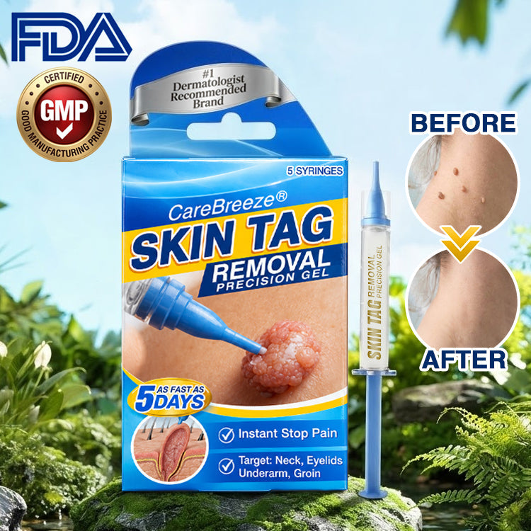 The Painless Way to Remove Skin Tags in 5 Days
