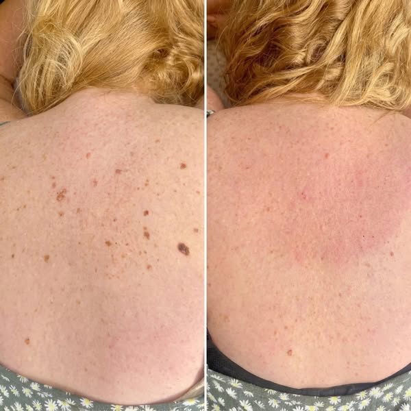 Read If Your Skin Barnacles Keep Coming Back