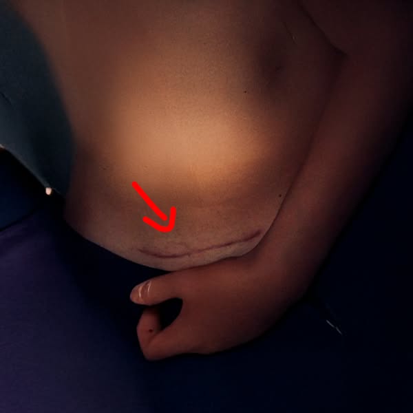 I Stopped Dressing Around My C-Section Scar