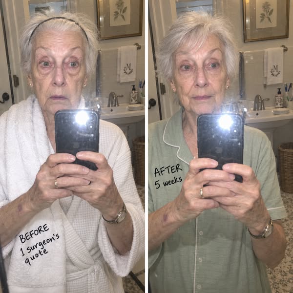 The Real Reason For Your Under-Eye Bags