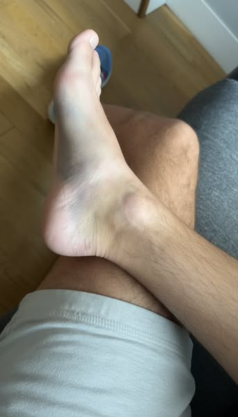 What Those Red Patches On Your Legs Mean