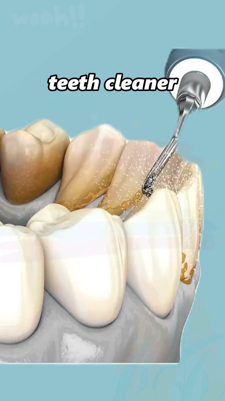 Remove Hardened Tartar Painlessly At Home