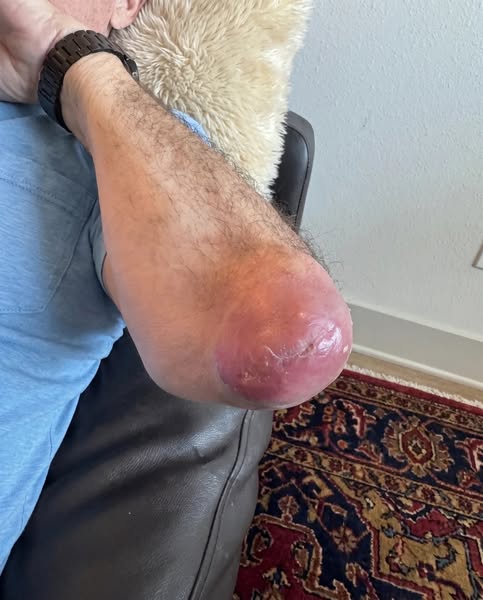Read this if you deal with gout
