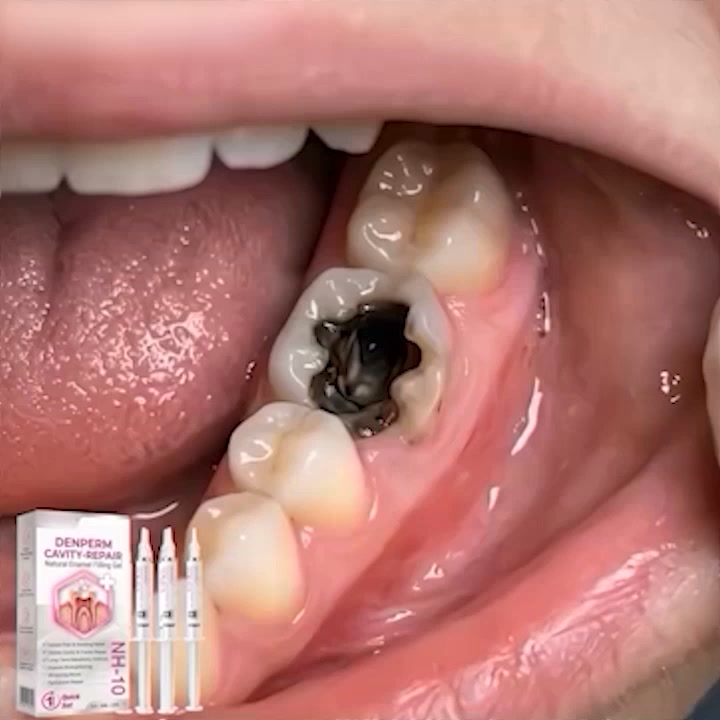 Cavity Repair FDA-Recognized 10% Nano-Hydroxyapatite (NH-10) | Delivery within 2-4 working days | Full refund guarantee