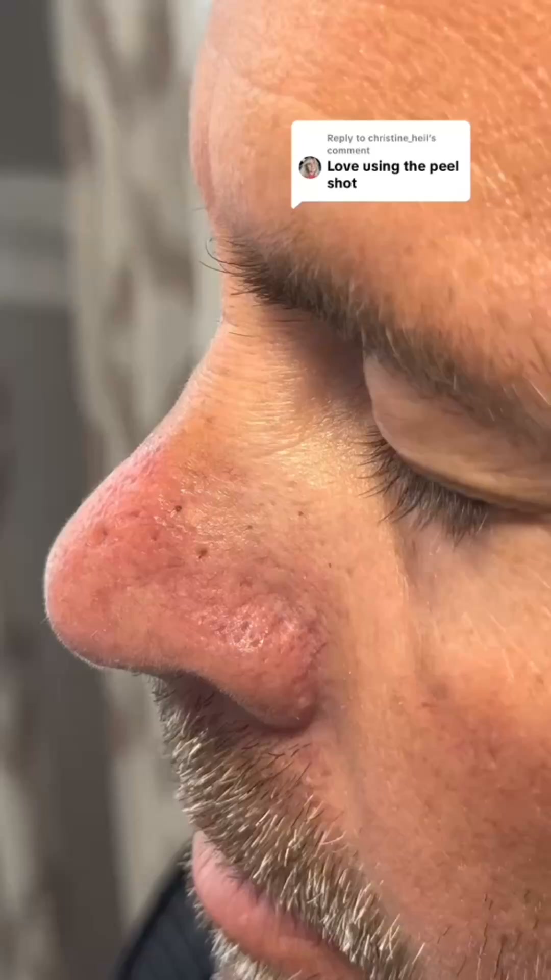 Say goodbye to blackheads