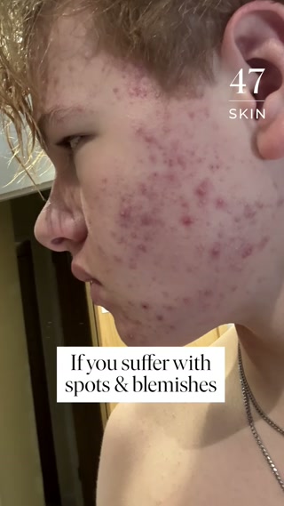 A skin treatment that actually works
