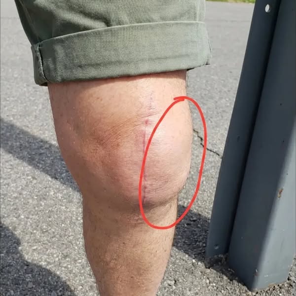 Read This If You Had A Knee Replacement