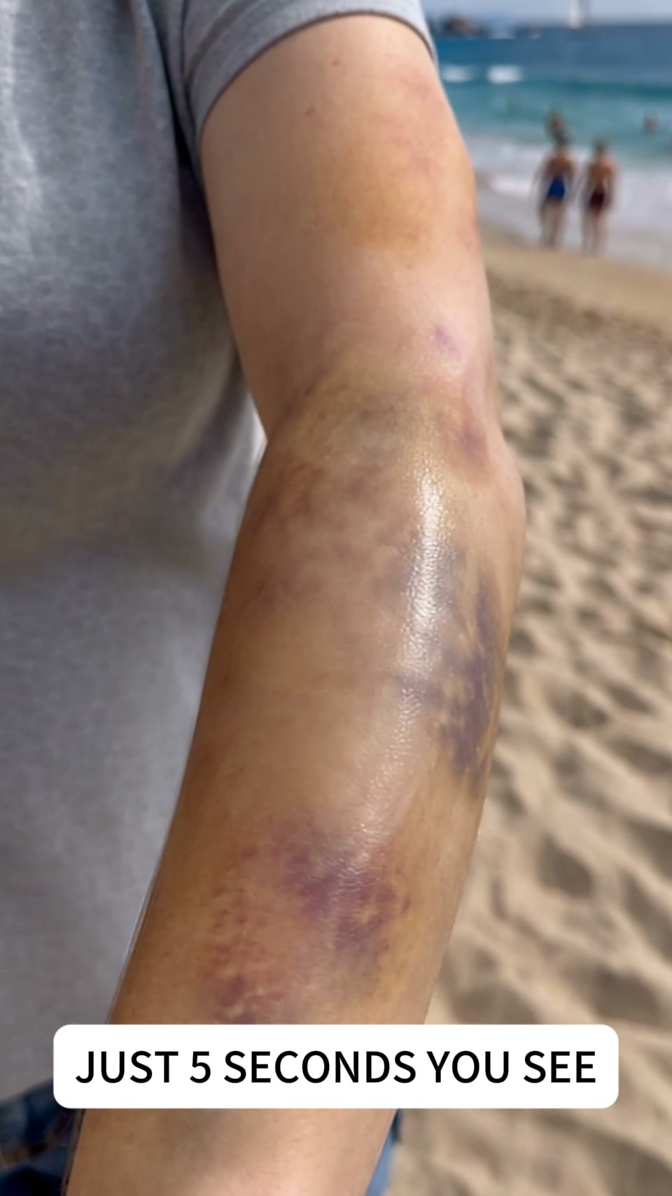 A slight bump shouldn't leave a mark for weeks.