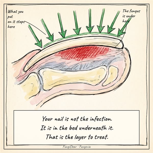 Read this if you have toe fungus
