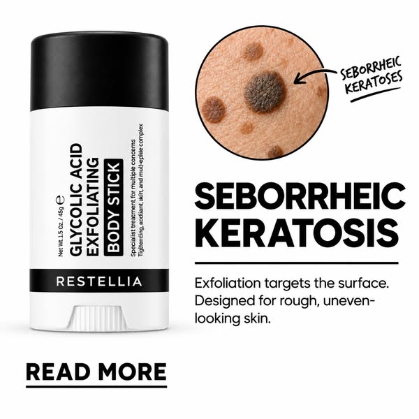 Finally Get Ahead Of Your Seborrheic Keratoses