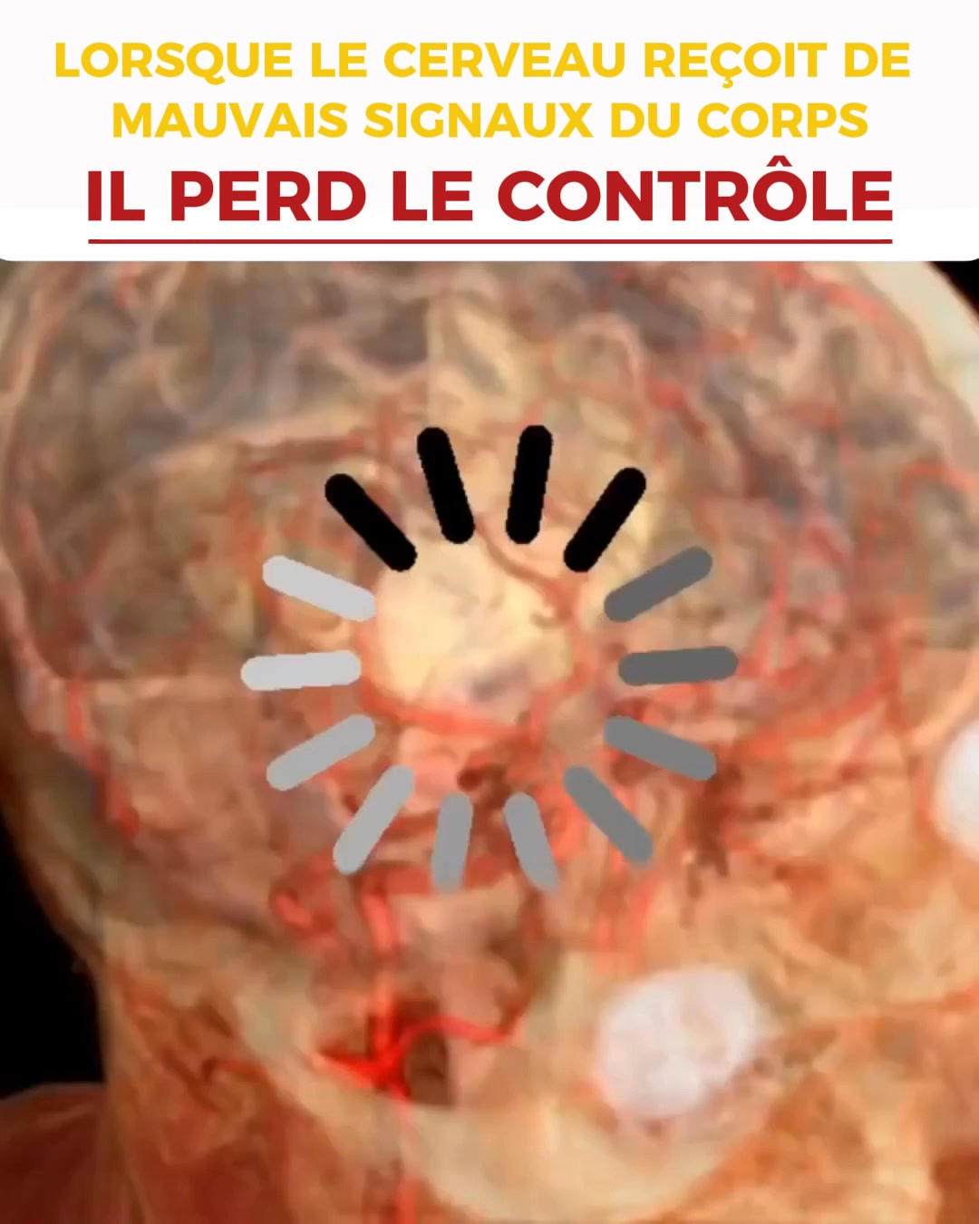 Pourquoi Vertiges, Tachycardie et Reflux Commencent Souvent dans le Cou