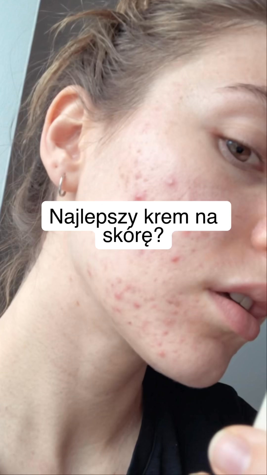 Co w jelitach, to na skórze.