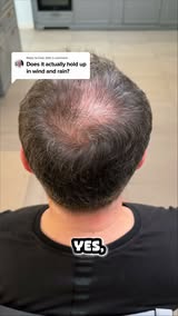 Seeing More Scalp Lately?