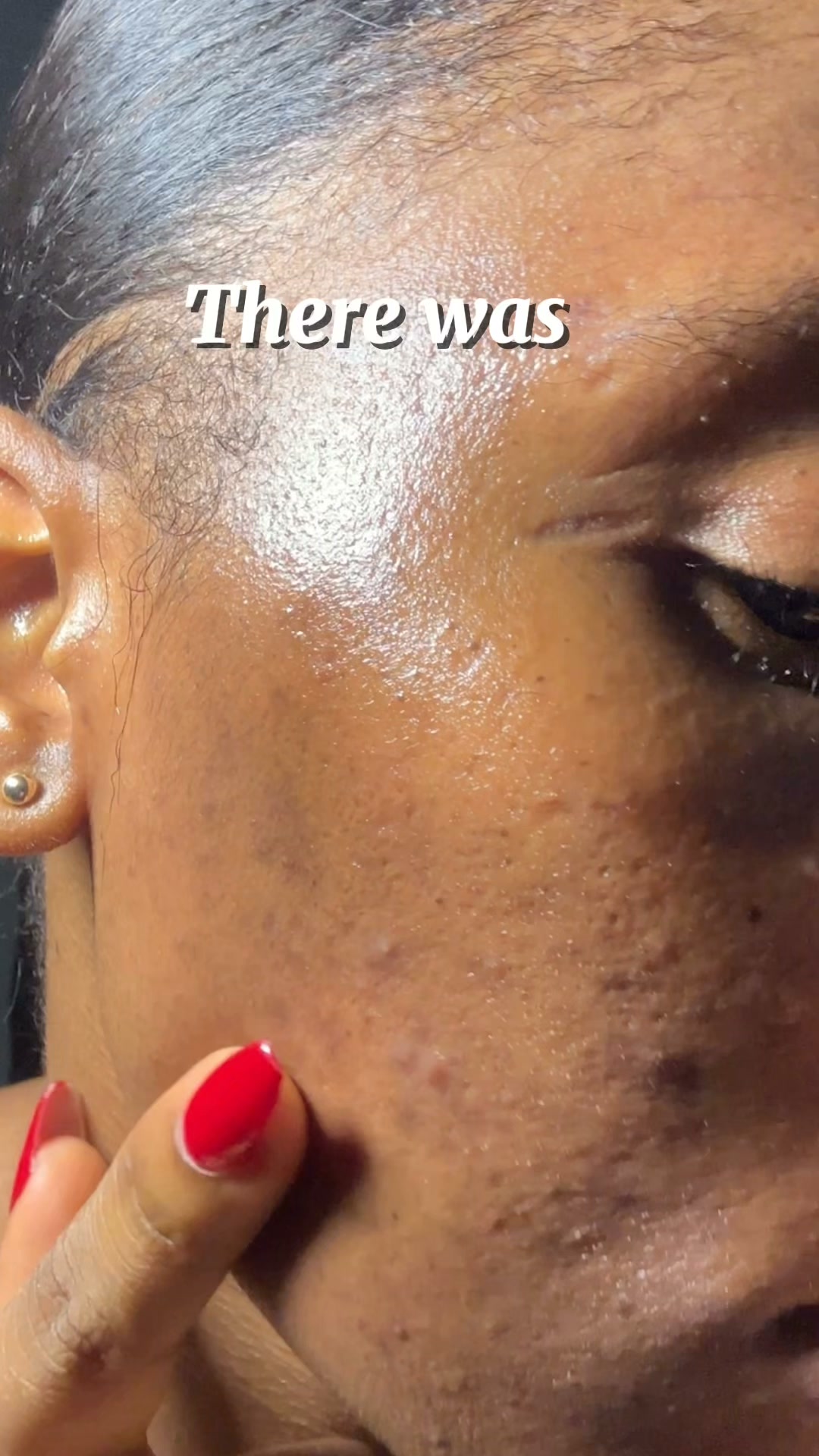 The Korean Answer To Acne’s Aftermath