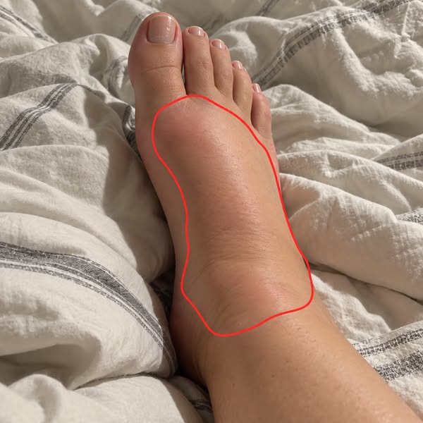 Her Gout Was “Controlled” While Her Kidneys Failed
