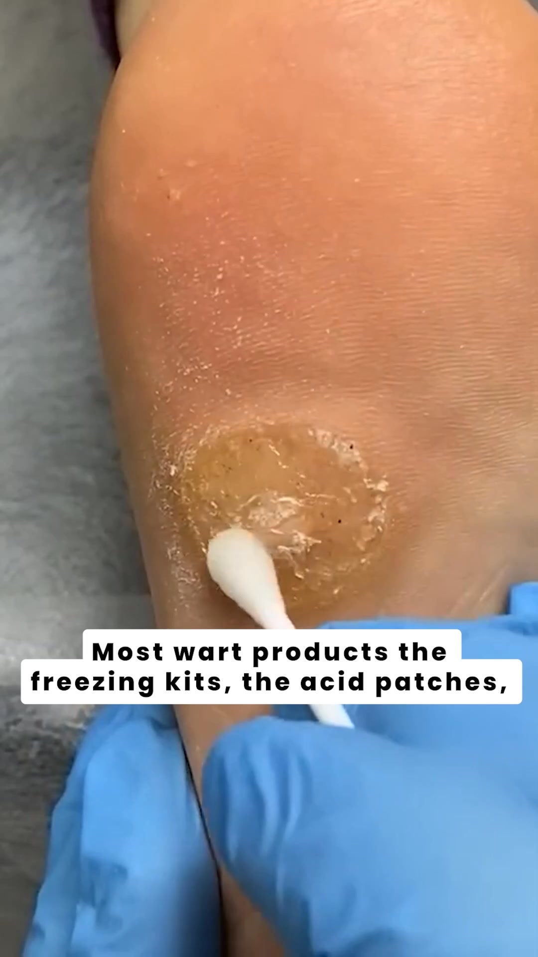 A Solution For Warts That Works