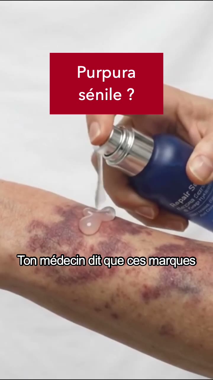 Ta peau marque au moindre choc ?