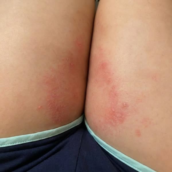 Feel Normal in Your Own Skin Again