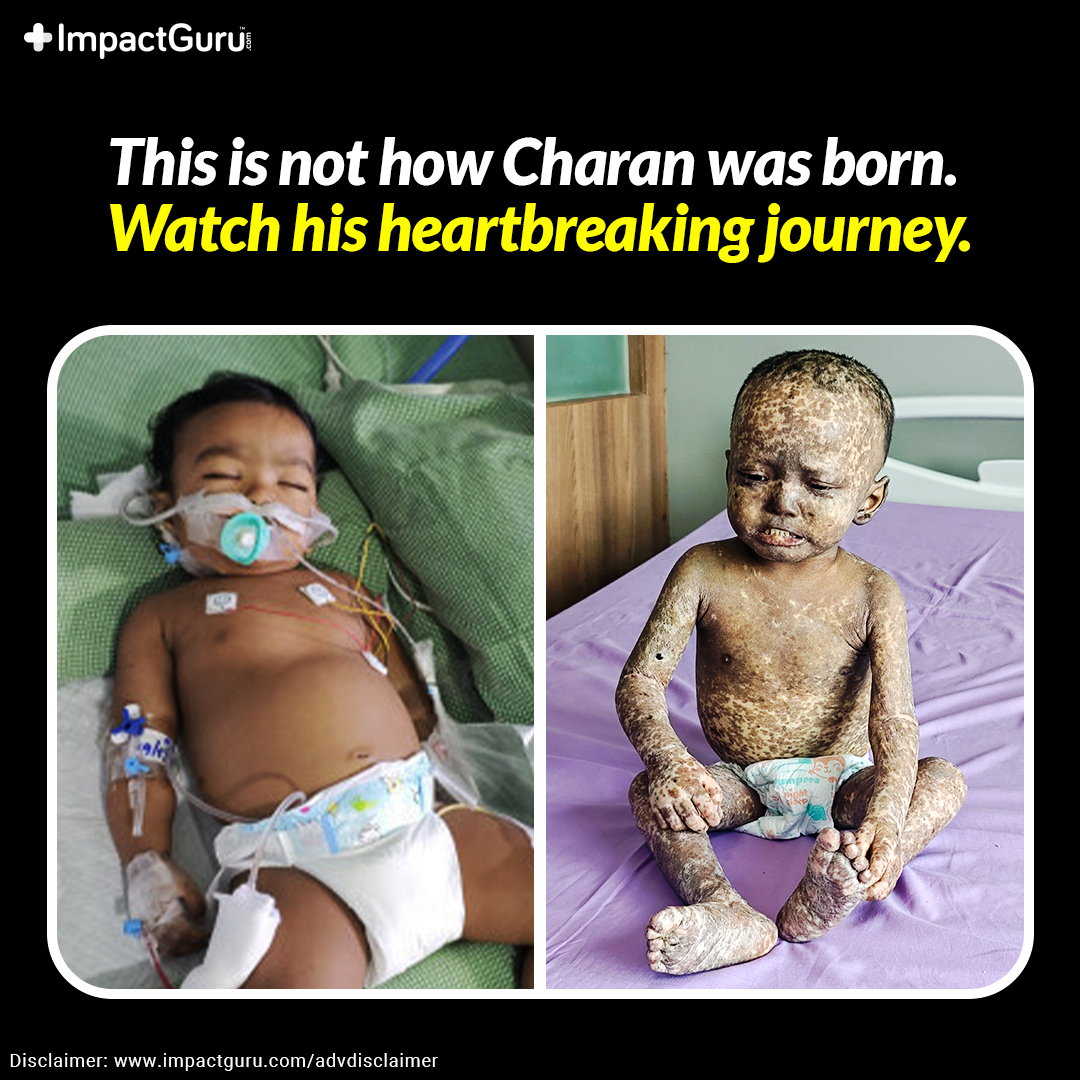 A Transplant Complication Is Peeling Charan’s Skin!