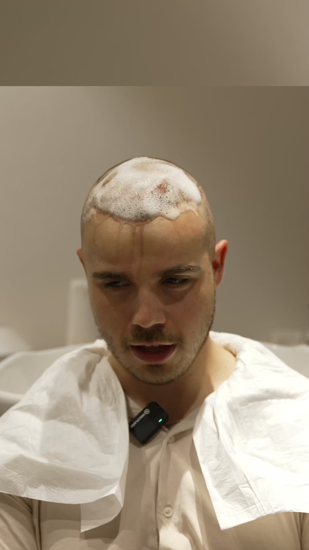 Hair Transplant in Turkey