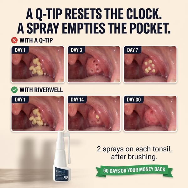 The 10 second spray for tonsil stones