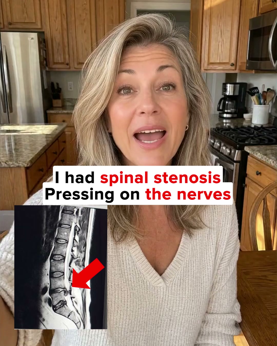 The deep muscle spinal stenosis switches off without warning