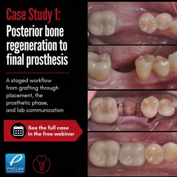 Implant case studies: single tooth to full arch