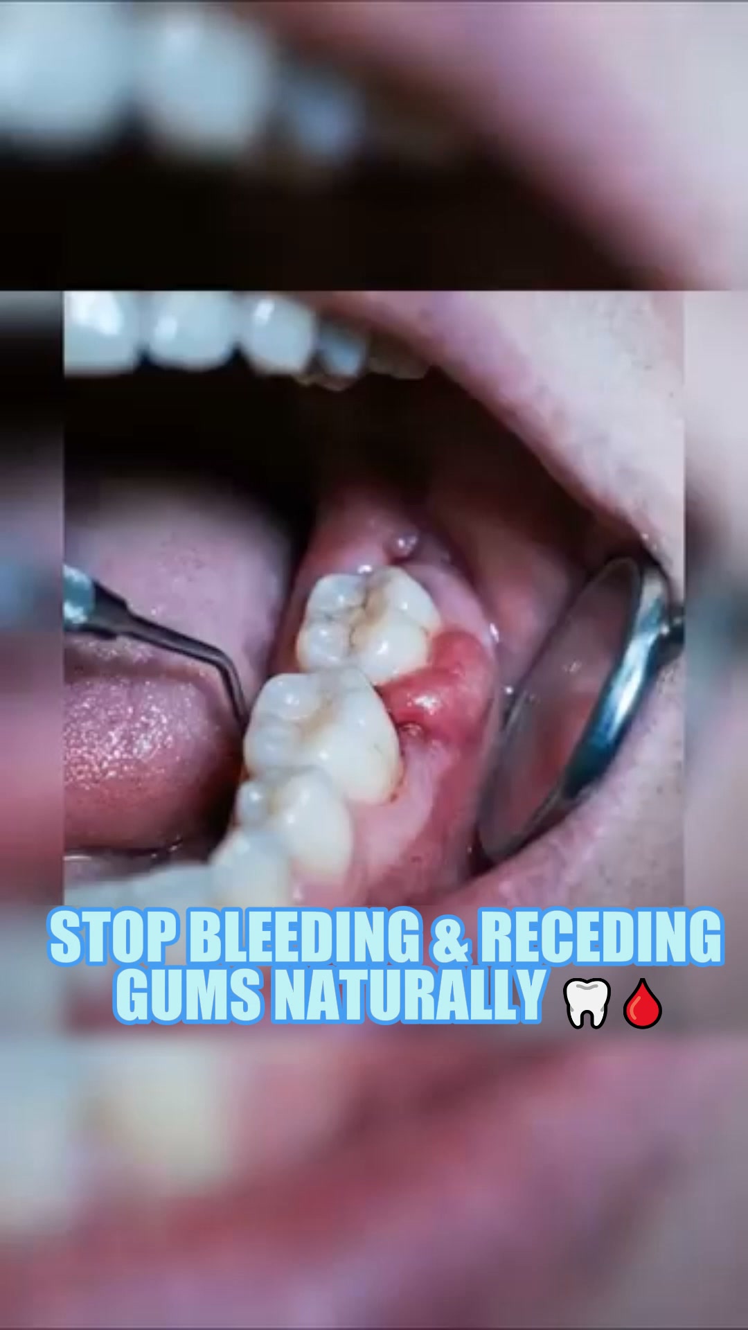 Stop Bleeding Gums & Pocket Depth — Visible Relief in 7 Days!