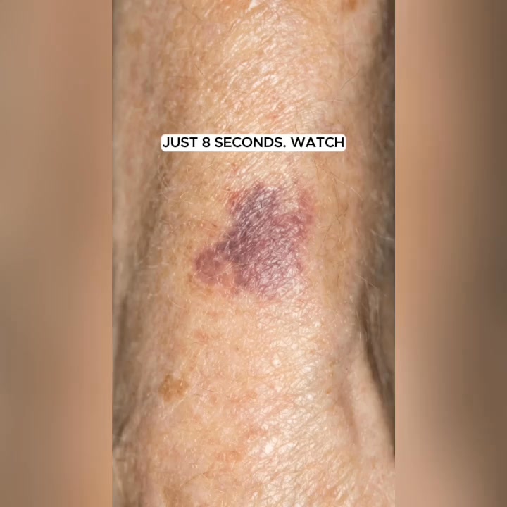 Purple spots visibly fading without waiting weeks