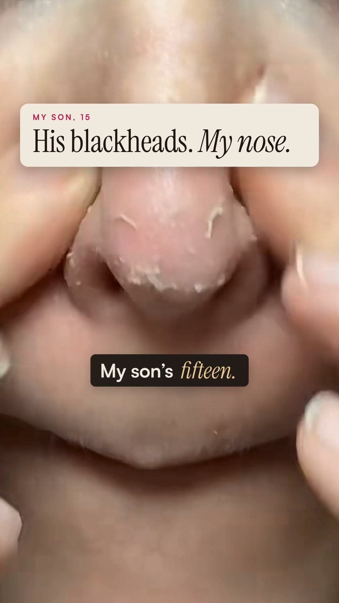 Say goodbye to blackheads