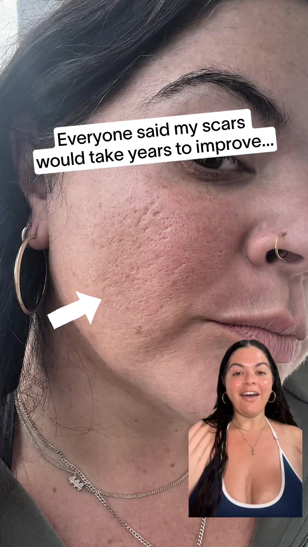 Smooth Your Acne Scars in 90 Days