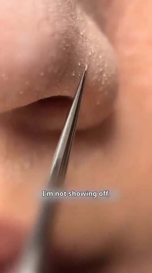 Professional Facial Blackhead Remover Tweezers