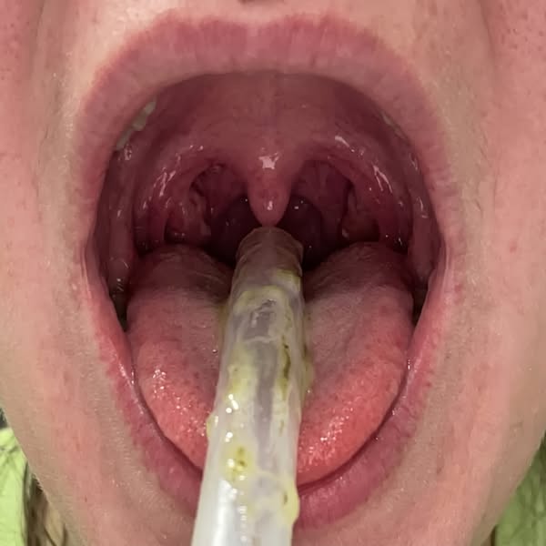 Her Chart Said Controlled. Her Lungs Said Otherwise